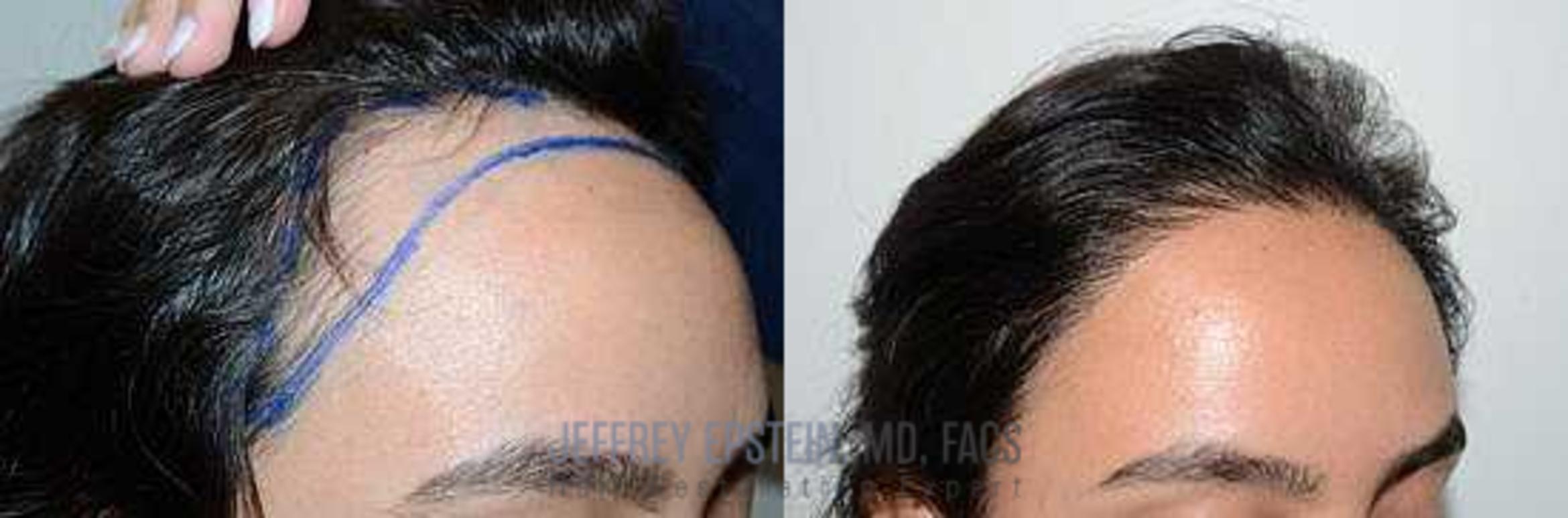 Before & After Hair Transplants For Women Case 232 View 1 View in Miami, FL