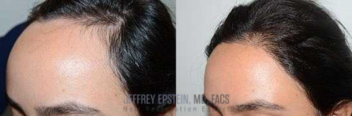 Before & After Hair Transplants For Women Case 232 View 2 View in Miami, FL