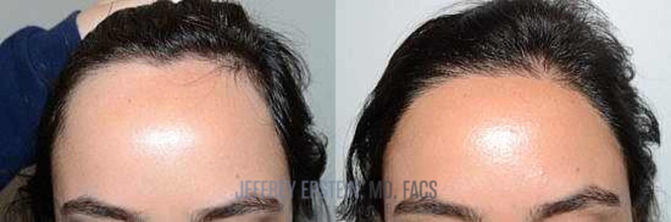 Before & After Hair Transplants For Women Case 232 View 3 View in Miami, FL