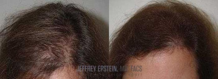 Before & After Hair Transplants For Women Case 233 View 1 View in Miami, FL