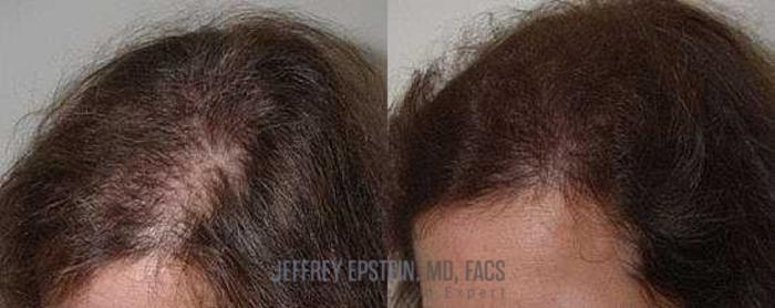 Before & After Hair Transplants For Women Case 233 View 2 View in Miami, FL