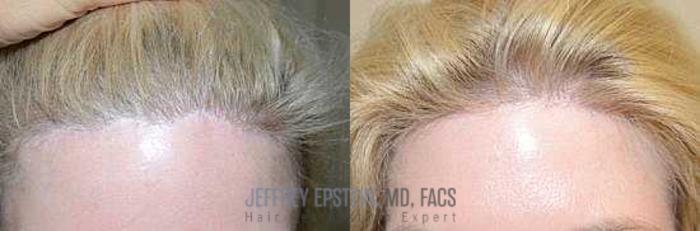 Before & After Hair Transplants For Women Case 234 View 1 View in Miami, FL