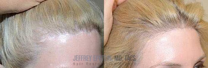 Before & After Hair Transplants For Women Case 234 View 2 View in Miami, FL
