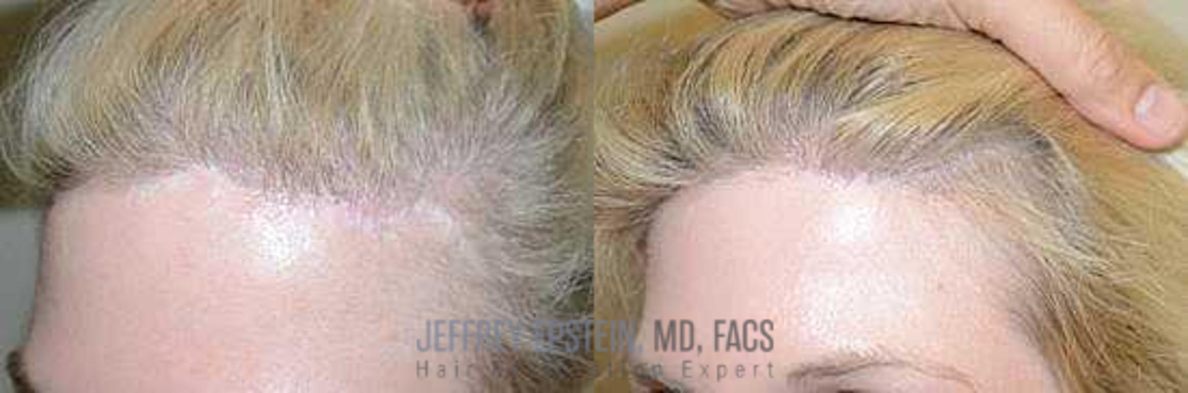 Before & After Hair Transplants For Women Case 234 View 3 View in Miami, FL