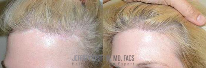 Before & After Hair Transplants For Women Case 234 View 3 View in Miami, FL