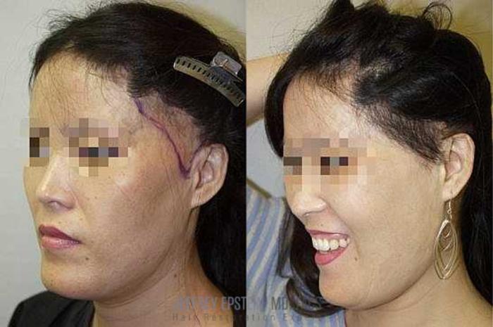 Before & After Hair Transplants For Women Case 235 View 1 View in Miami, FL