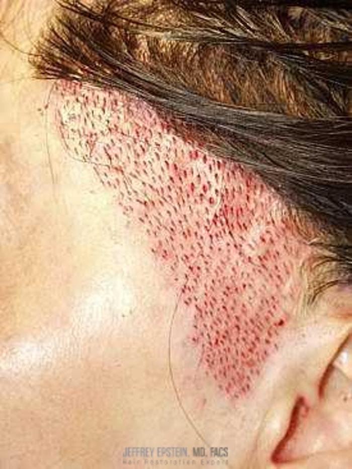 Before & After Hair Transplants For Women Case 235 View 2 View in Miami, FL
