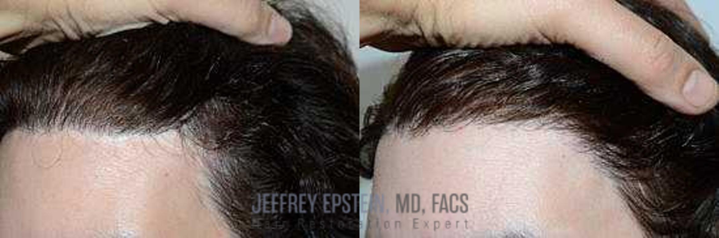 Before & After Hair Transplants For Women Case 237 View 1 View in Miami, FL