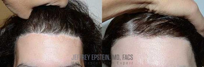 Before & After Hair Transplants For Women Case 237 View 2 View in Miami, FL