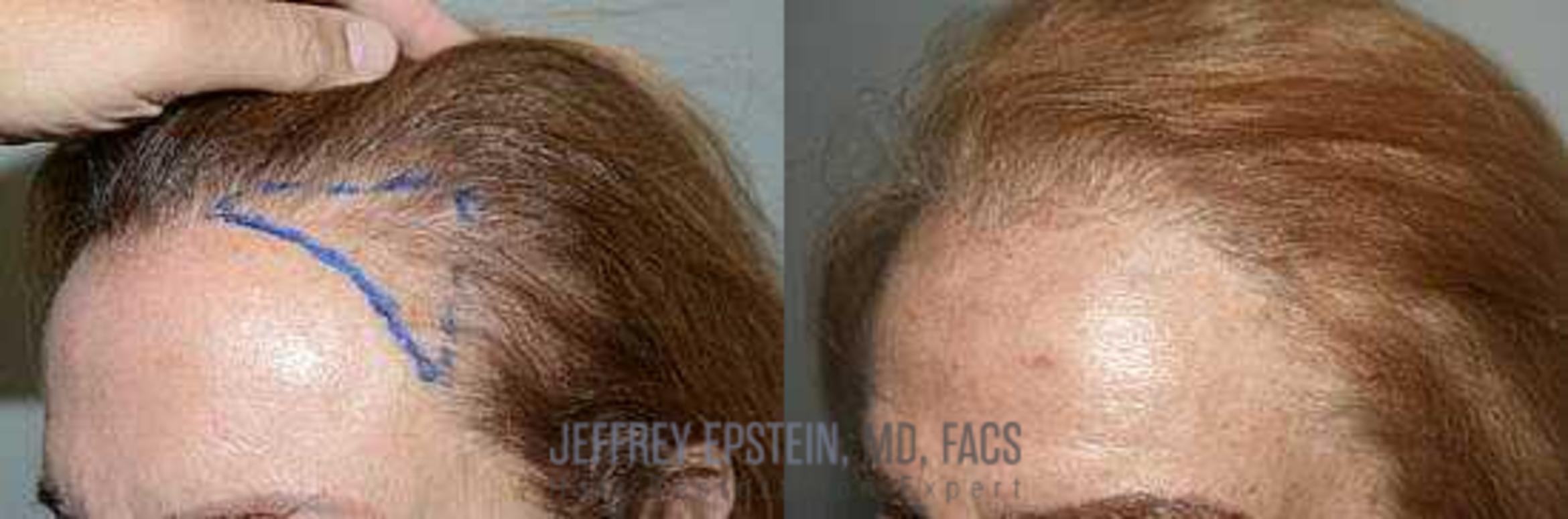 Before & After Hair Transplants For Women Case 261 View 1 View in Miami, FL