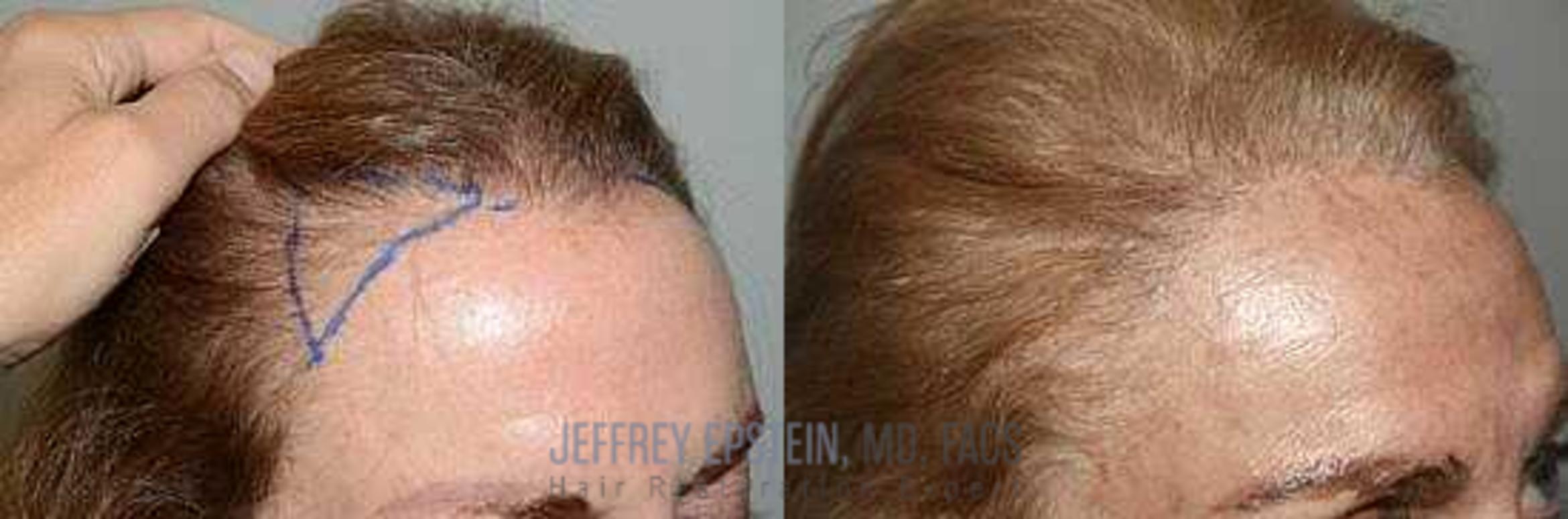 Before & After Hair Transplants For Women Case 261 View 2 View in Miami, FL