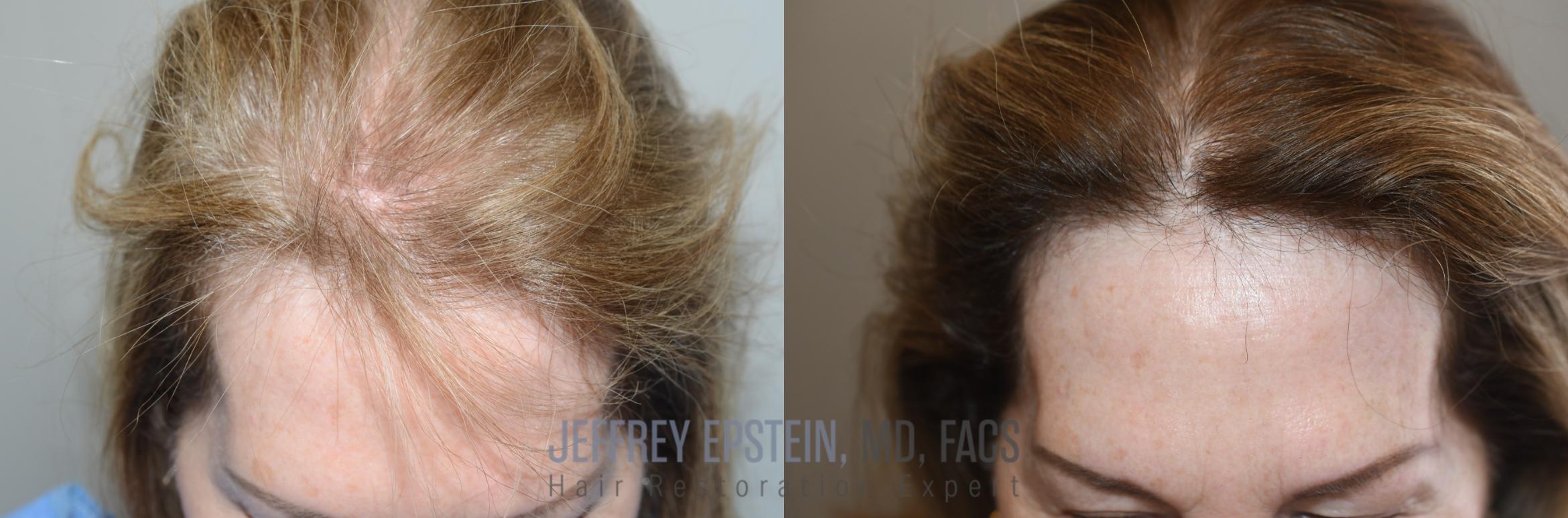 Before & After Hair Transplants For Women Case 264 Front View in Miami, FL