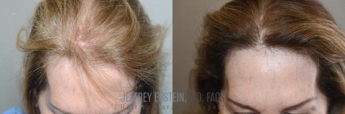 Before & After Hair Transplants For Women Case 264 Front View in Miami, FL