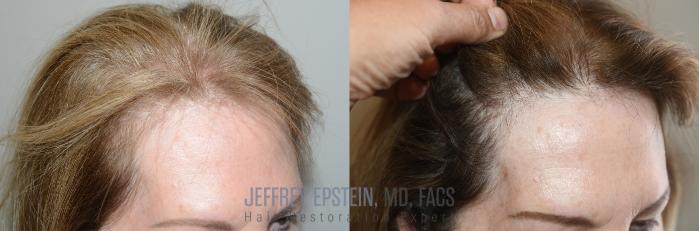 Before & After Hair Transplants For Women Case 264 Right Side View in Miami, FL