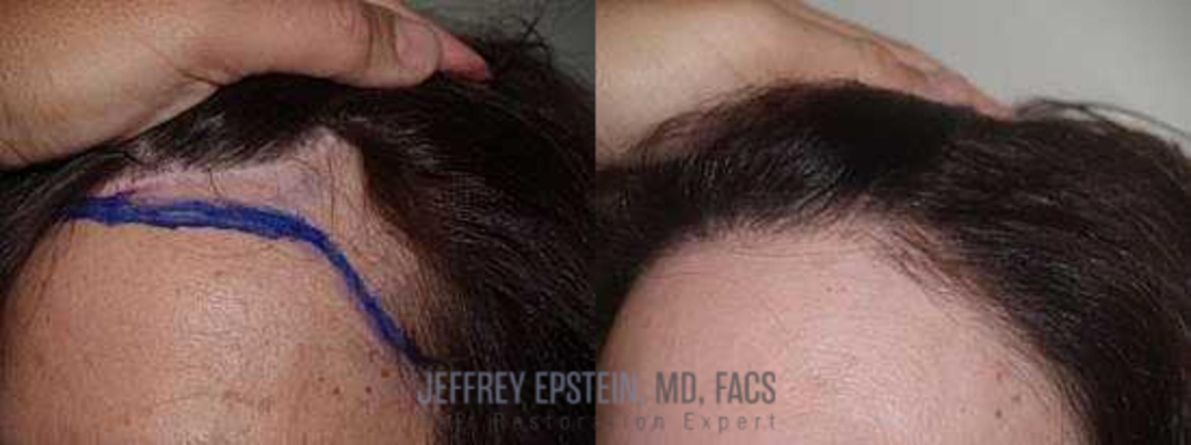 Before & After Hair Transplants For Women Case 284 View 1 View in Miami, FL