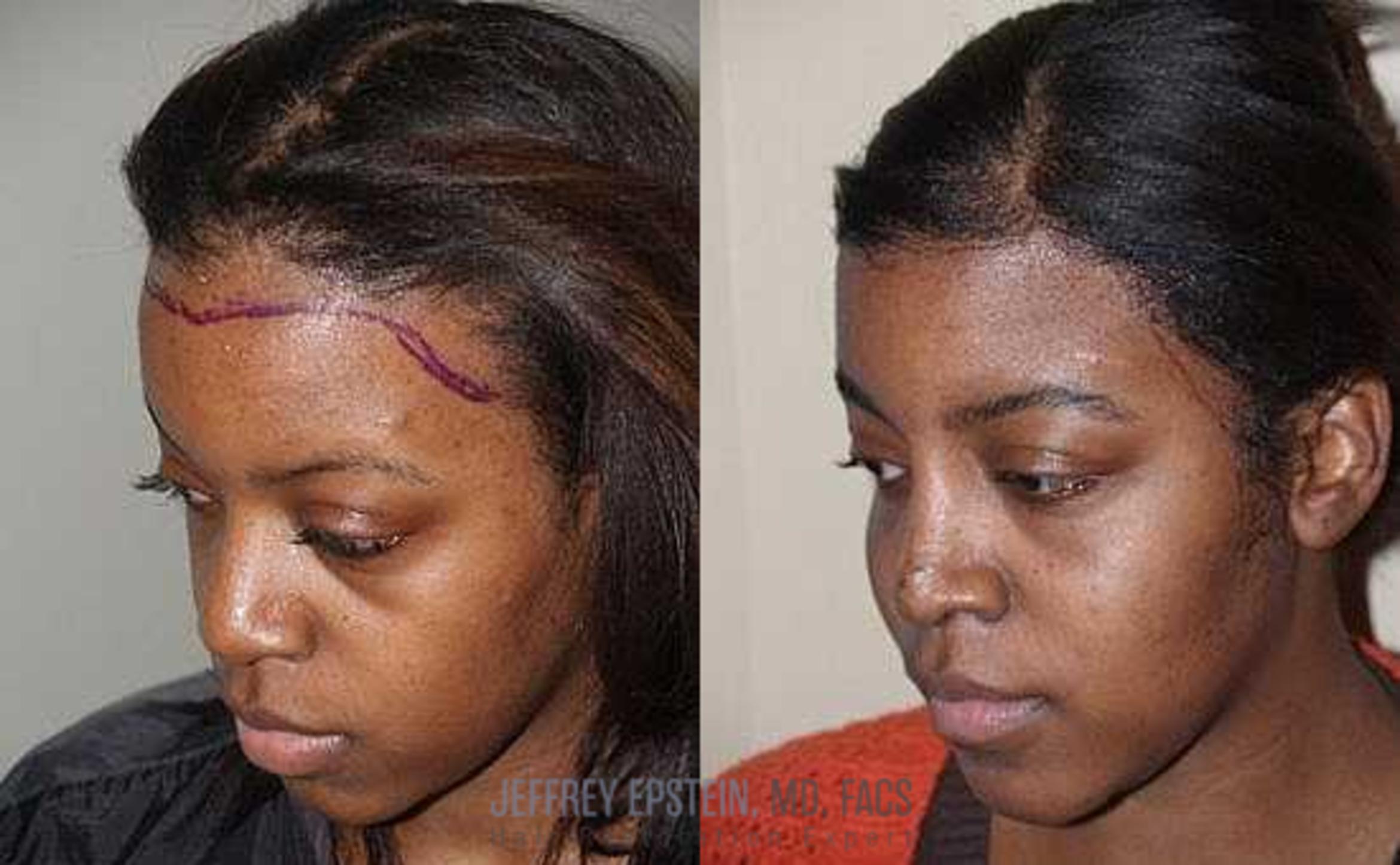 Before & After Hair Transplants For Women Case 289 View 1 View in Miami, FL