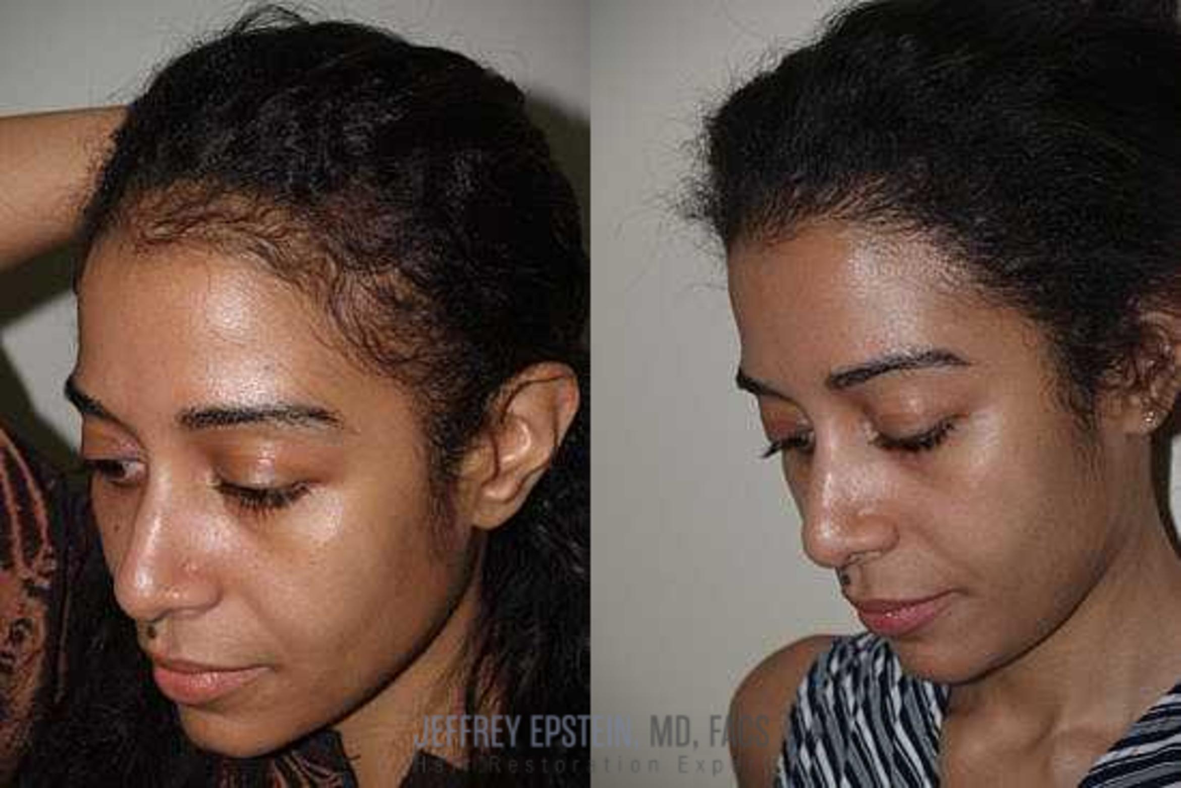 Before & After Hair Transplants For Women Case 293 View 1 View in Miami, FL