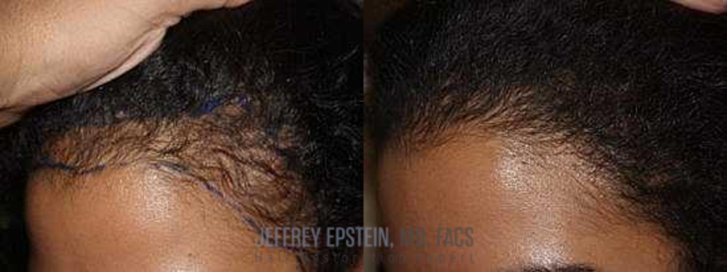 Before & After Hair Transplants For Women Case 293 View 2 View in Miami, FL