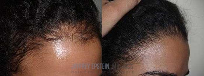 Before & After Hair Transplants For Women Case 293 View 3 View in Miami, FL