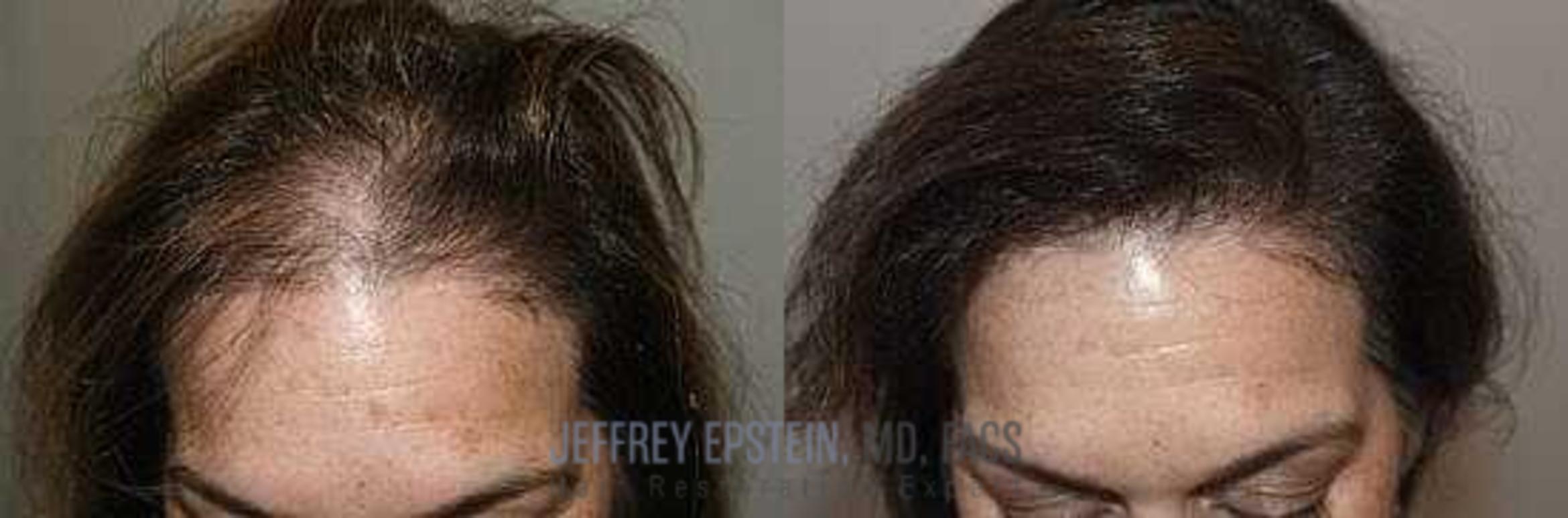 Before & After Hair Transplants For Women Case 346 View 1 View in Miami, FL