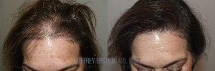 Before & After Hair Transplants For Women Case 346 View 1 View in Miami, FL