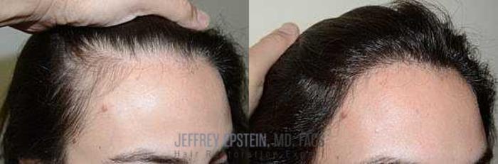 Before & After Hair Transplants For Women Case 356 View 1 View in Miami, FL
