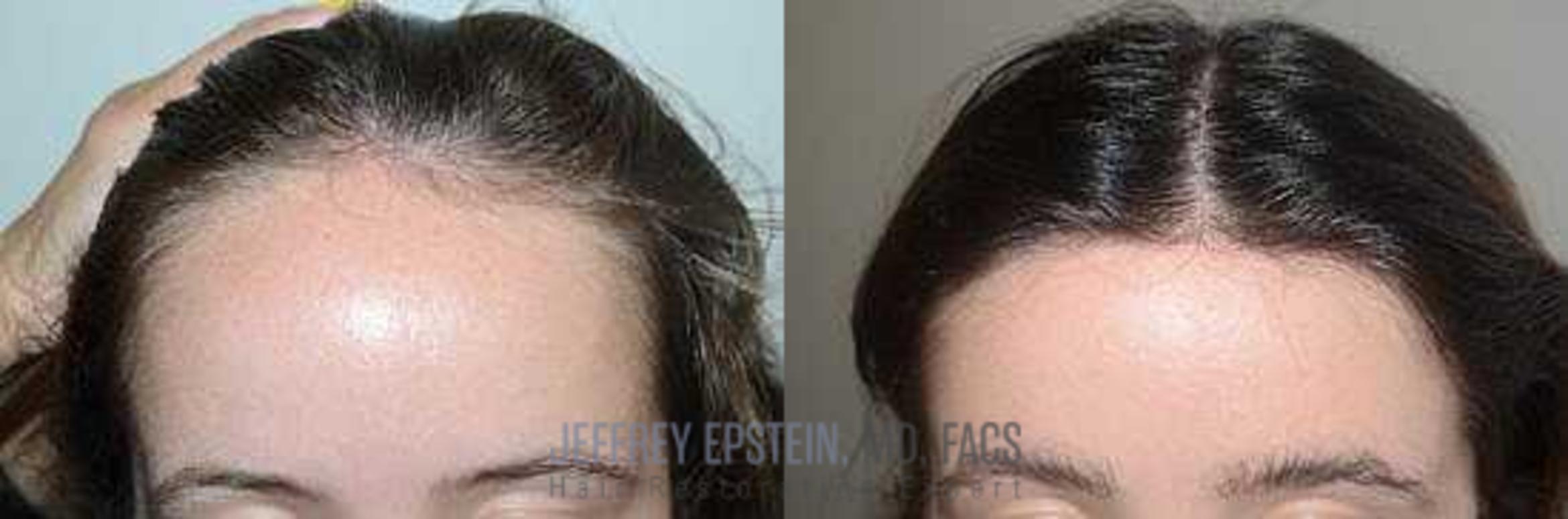 Before & After Hairline Lowering / Forehead Reduction Case 238 View 1 View in Miami, FL