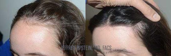 Before & After Hairline Lowering / Forehead Reduction Case 238 View 2 View in Miami, FL