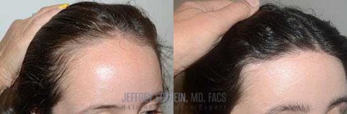 Before & After Hairline Lowering / Forehead Reduction Case 238 View 3 View in Miami, FL