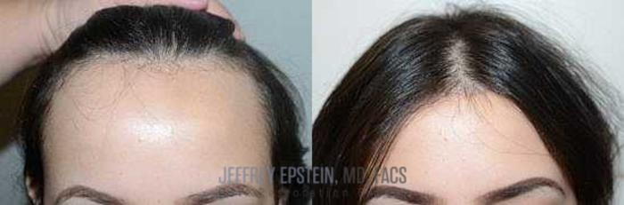 Before & After Hairline Lowering / Forehead Reduction Case 239 View 1 View in Miami, FL