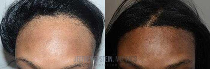 Before & After Hairline Lowering / Forehead Reduction Case 241 View 1 View in Miami, FL