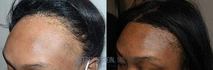 Before & After Hairline Lowering / Forehead Reduction Case 241 View 2 View in Miami, FL