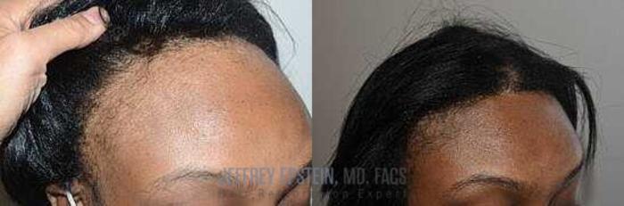 Before & After Hairline Lowering / Forehead Reduction Case 241 View 3 View in Miami, FL