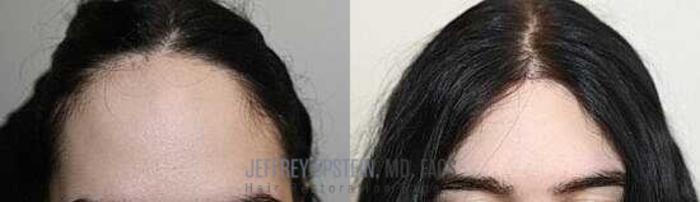 Before & After Hairline Lowering / Forehead Reduction Case 242 View 1 View in Miami, FL