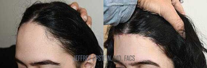 Before & After Hairline Lowering / Forehead Reduction Case 242 View 2 View in Miami, FL