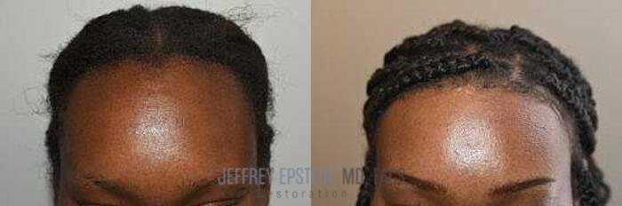 Before & After Hairline Lowering / Forehead Reduction Case 243 View 1 View in Miami, FL
