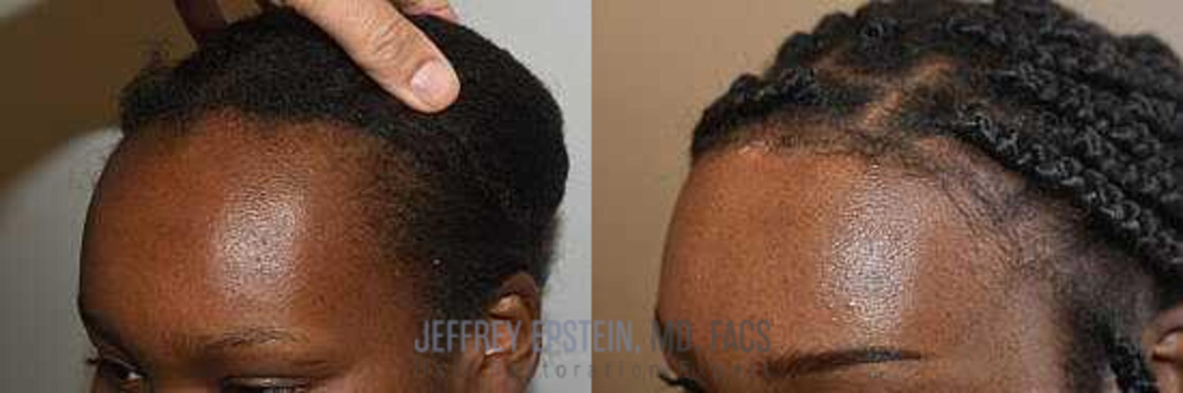 Before & After Hairline Lowering / Forehead Reduction Case 243 View 2 View in Miami, FL