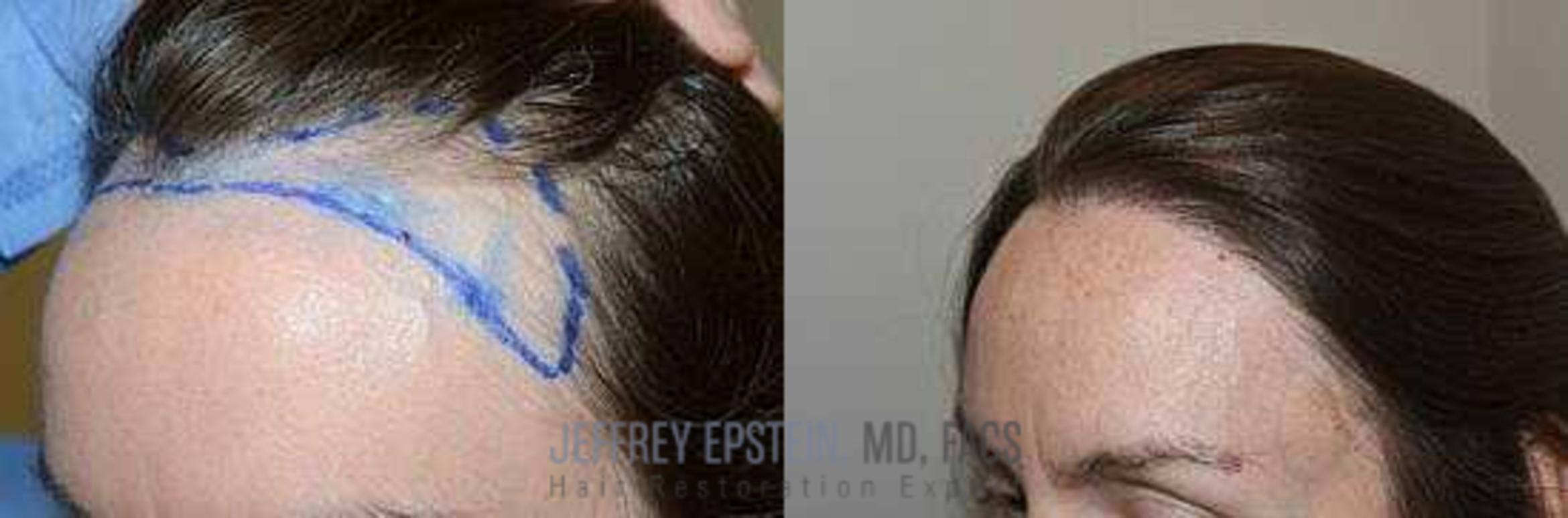 Before & After Hairline Lowering / Forehead Reduction Case 244 View 1 View in Miami, FL