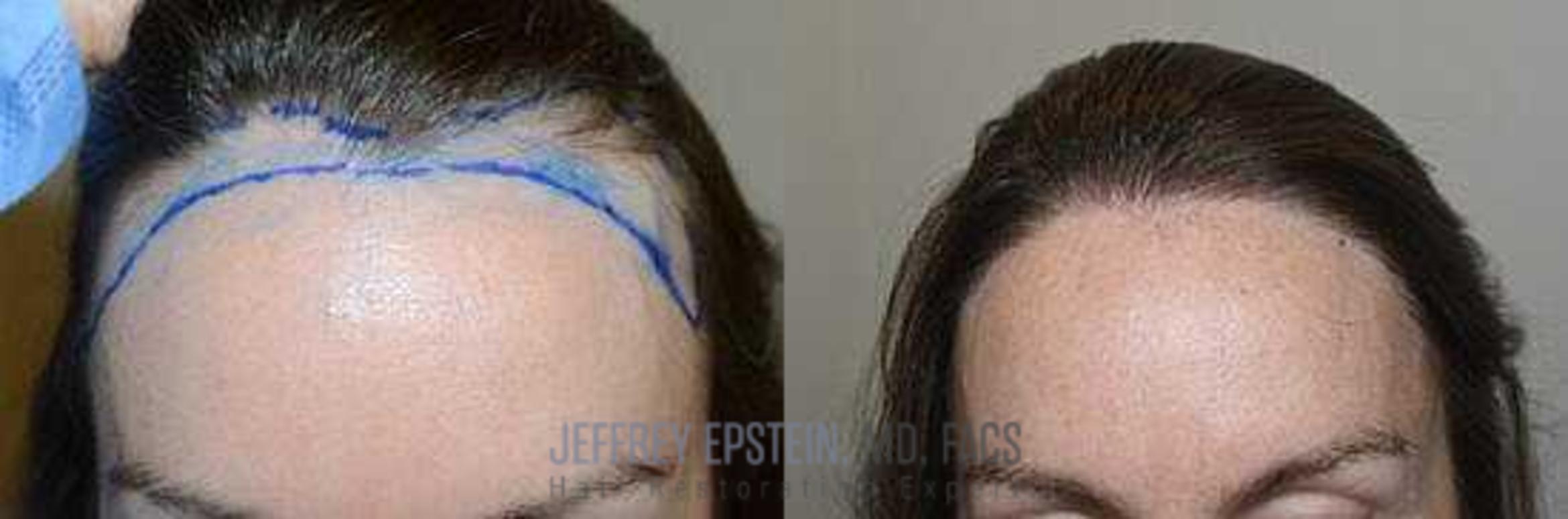 Before & After Hairline Lowering / Forehead Reduction Case 244 View 2 View in Miami, FL
