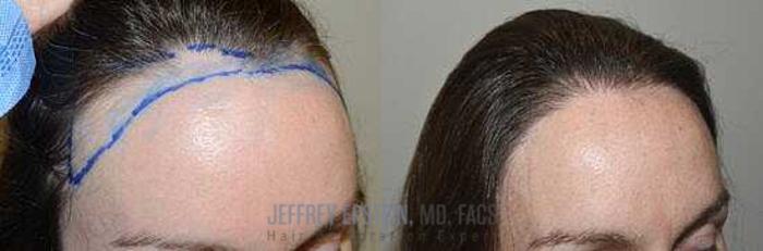 Before & After Hairline Lowering / Forehead Reduction Case 244 View 3 View in Miami, FL