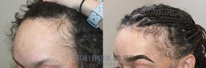 Before & After Hairline Lowering / Forehead Reduction Case 245 View 1 View in Miami, FL