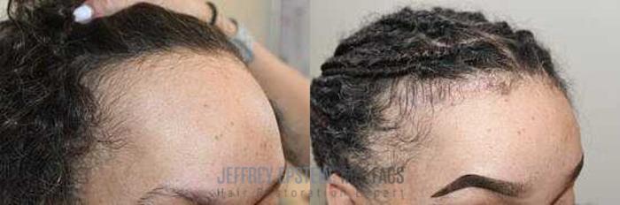 Before & After Hairline Lowering / Forehead Reduction Case 245 View 2 View in Miami, FL