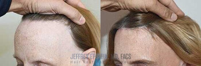 Before & After Hairline Lowering / Forehead Reduction Case 246 View 1 View in Miami, FL
