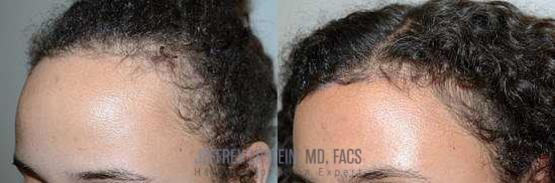 Before & After Hairline Lowering / Forehead Reduction Case 247 View 1 View in Miami, FL