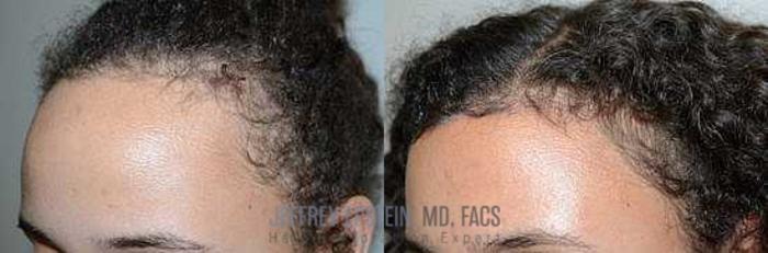 Before & After Hairline Lowering / Forehead Reduction Case 247 View 1 View in Miami, FL