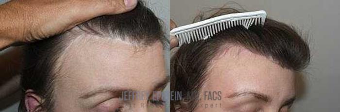 Before & After Hairline Lowering / Forehead Reduction Case 248 View 1 View in Miami, FL