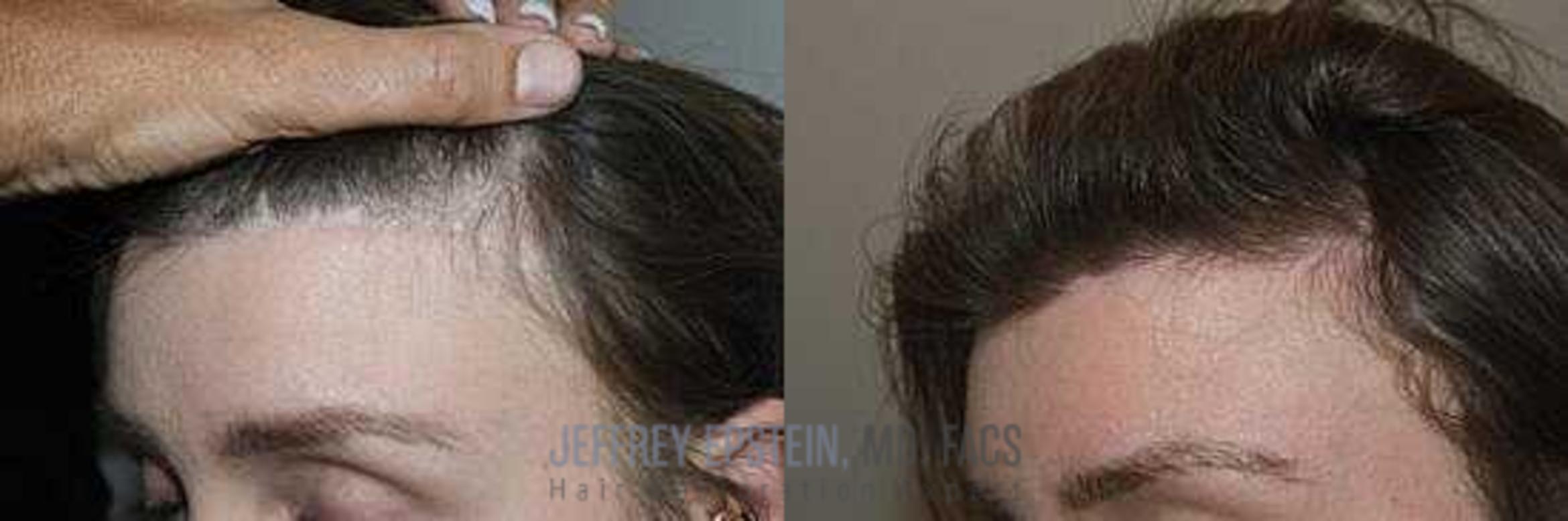 Before & After Hairline Lowering / Forehead Reduction Case 248 View 2 View in Miami, FL