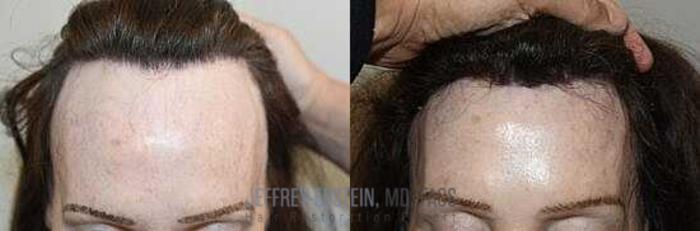 Before & After Hairline Lowering / Forehead Reduction Case 249 View 1 View in Miami, FL