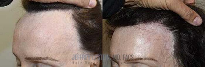 Before & After Hairline Lowering / Forehead Reduction Case 249 View 2 View in Miami, FL