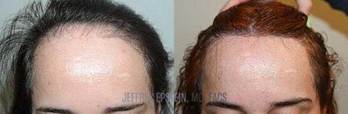 Before & After Hairline Lowering / Forehead Reduction Case 250 View 2 View in Miami, FL